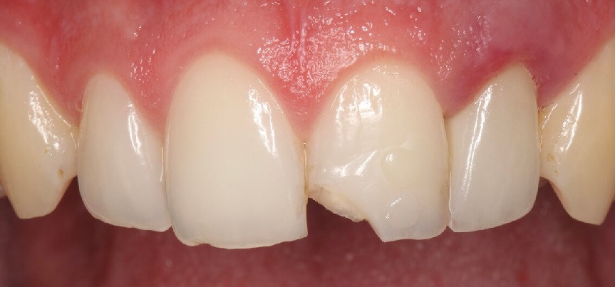 odlomeny zub 6